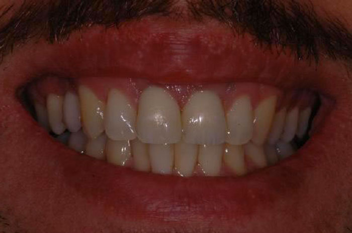 Trattamento Denti Devitalizzati a Roma